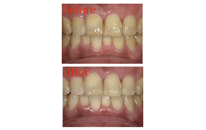 うるつやホワイトニング　症例 01