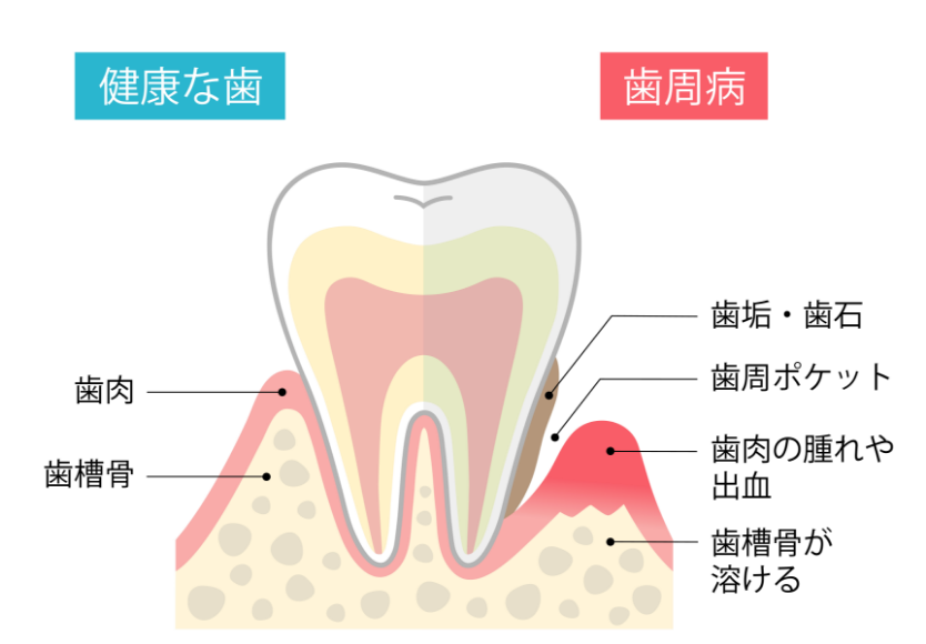 歯周病